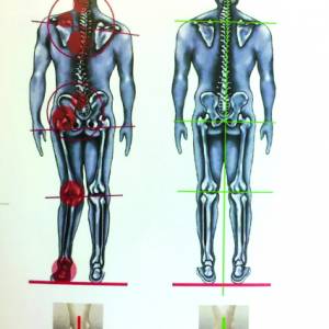 Fysiotherapiepraktijk ‘De Fysiotherapeute’  uit Stiens maakt inlegzolen die werken